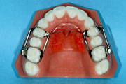 固定式上顎大臼歯後方移動装置（GMD)