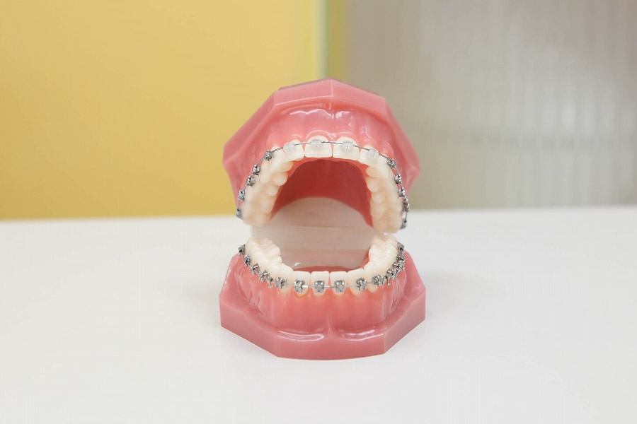 ジョイスマイル矯正歯科のセルフライゲーションブラケット装置（デーモンシステム）